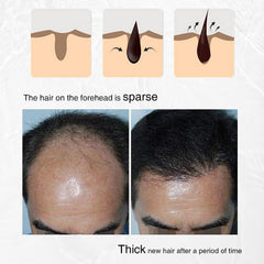 Hair Growth Spray, Organic Onion Oil with Rosemary Scent, Enriched with Black Seed Oil, Controls Hair Loss, Promotes Growth, for Women and Men